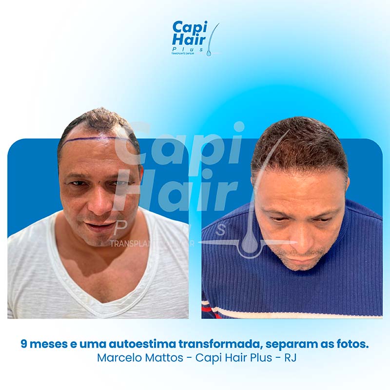 capihair-antes-depois-01