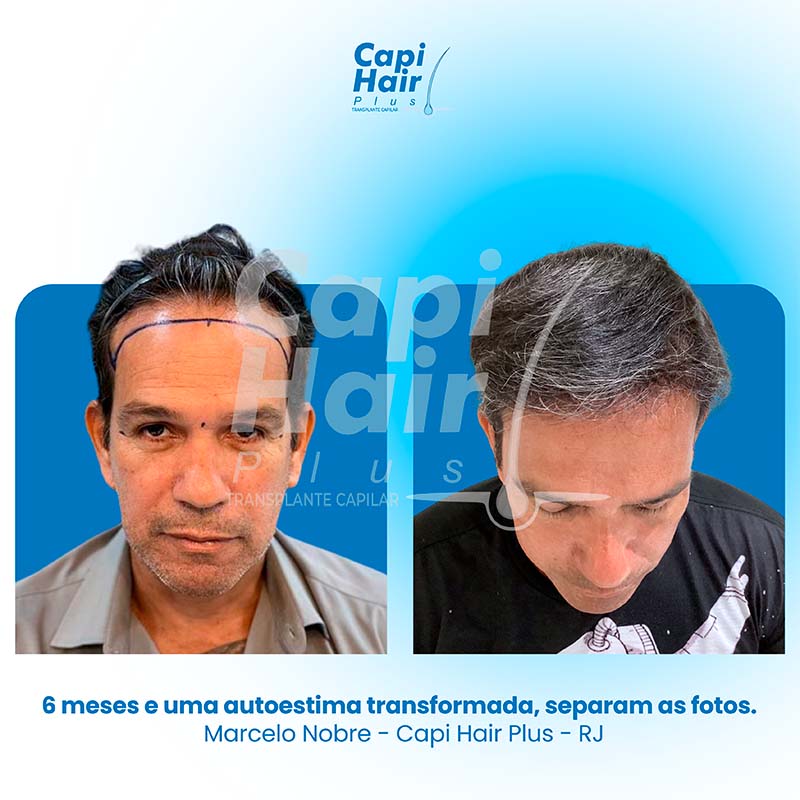 capihair-antes-depois-03