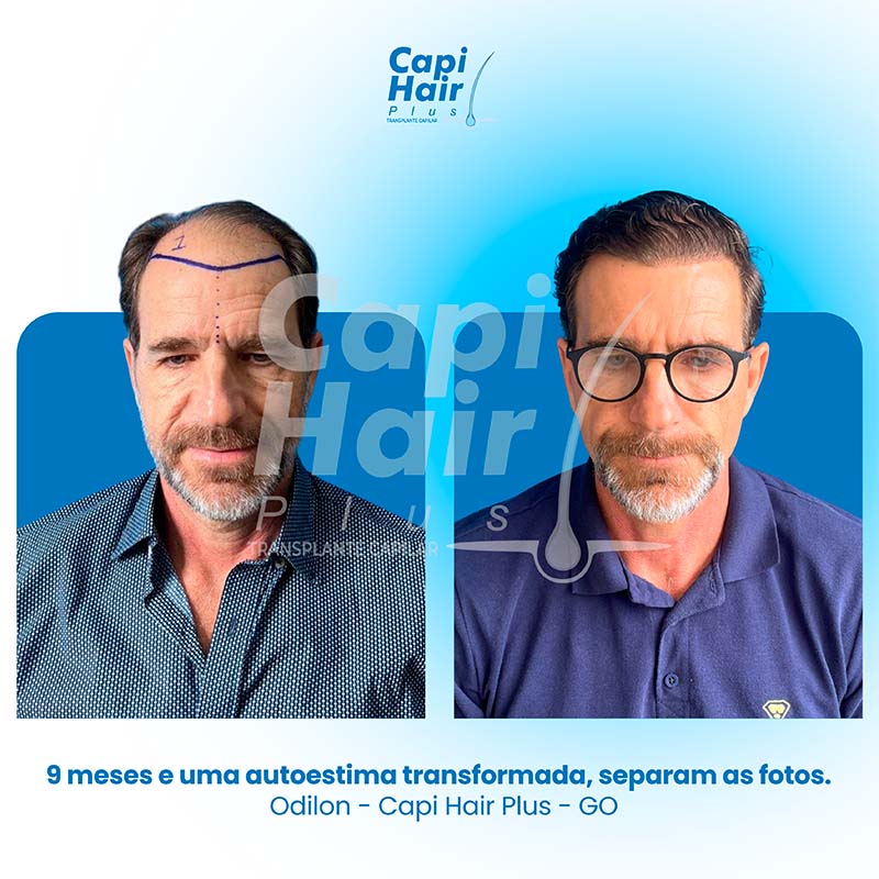 capihair-antes-depois-07