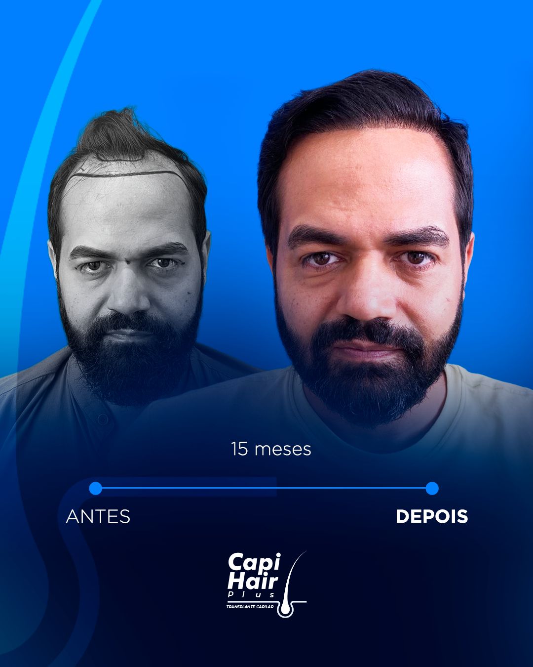 capihair-antes-depois-pacientes (1)