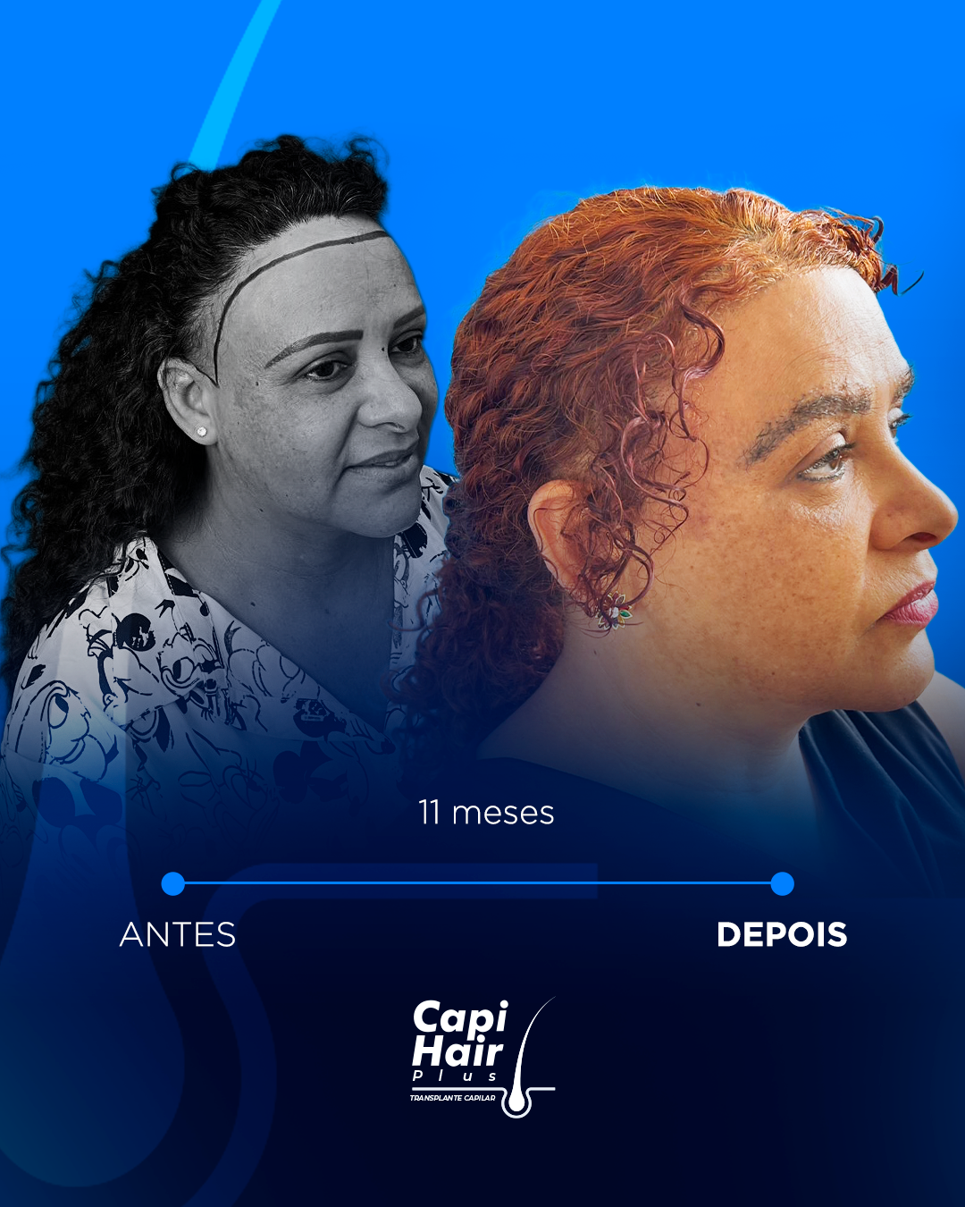 capihair-antes-depois-pacientes (1)