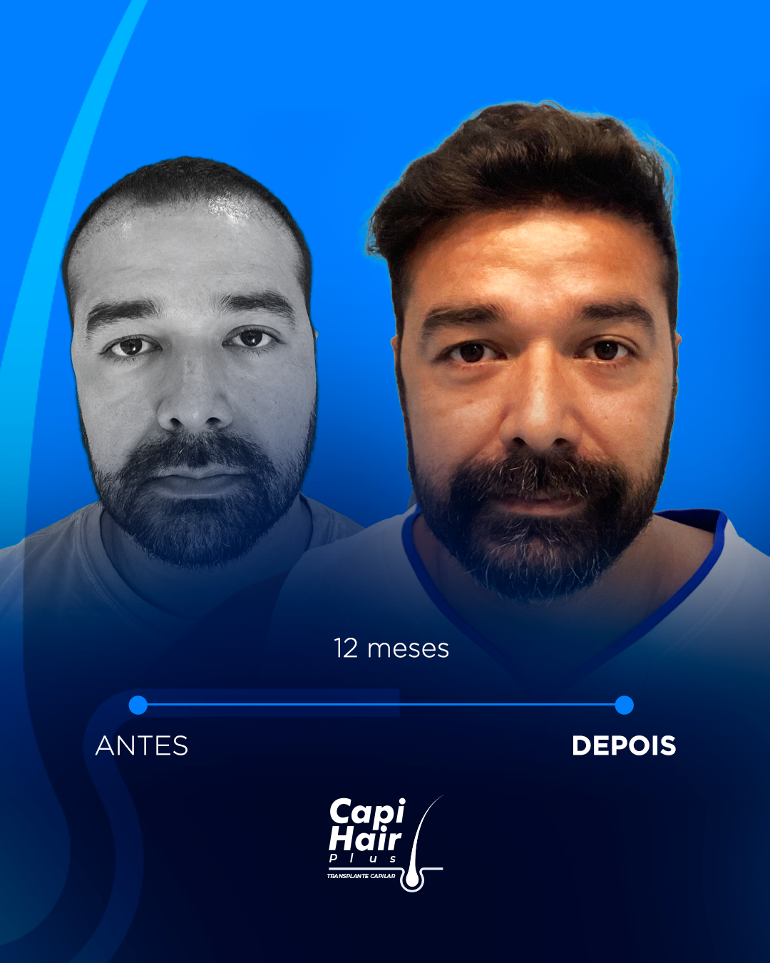 capihair-antes-depois-pacientes (2)