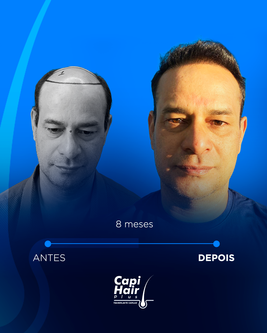 capihair-antes-depois-pacientes (3)