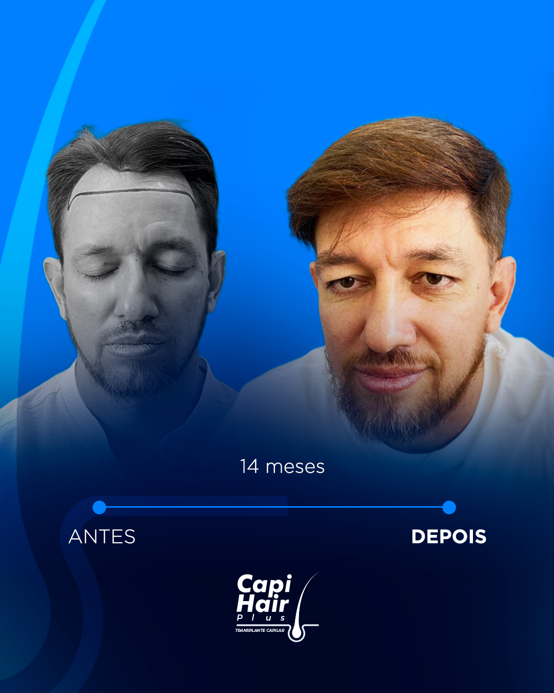 capihair-antes-depois-pacientes (4)