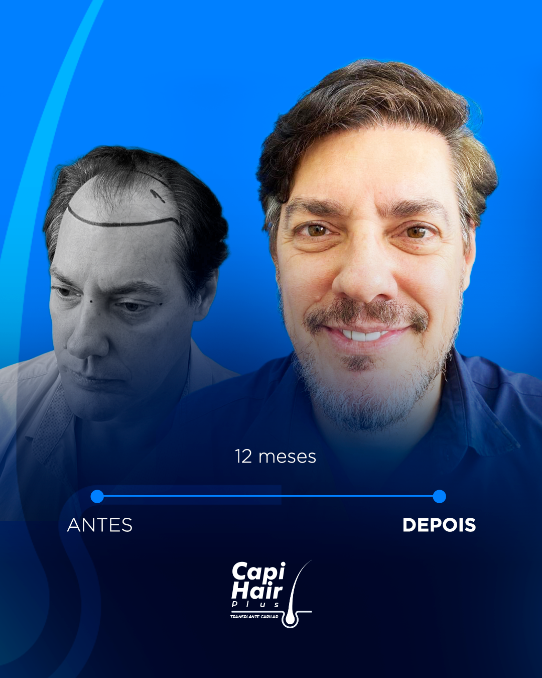 capihair-antes-depois-pacientes (5)