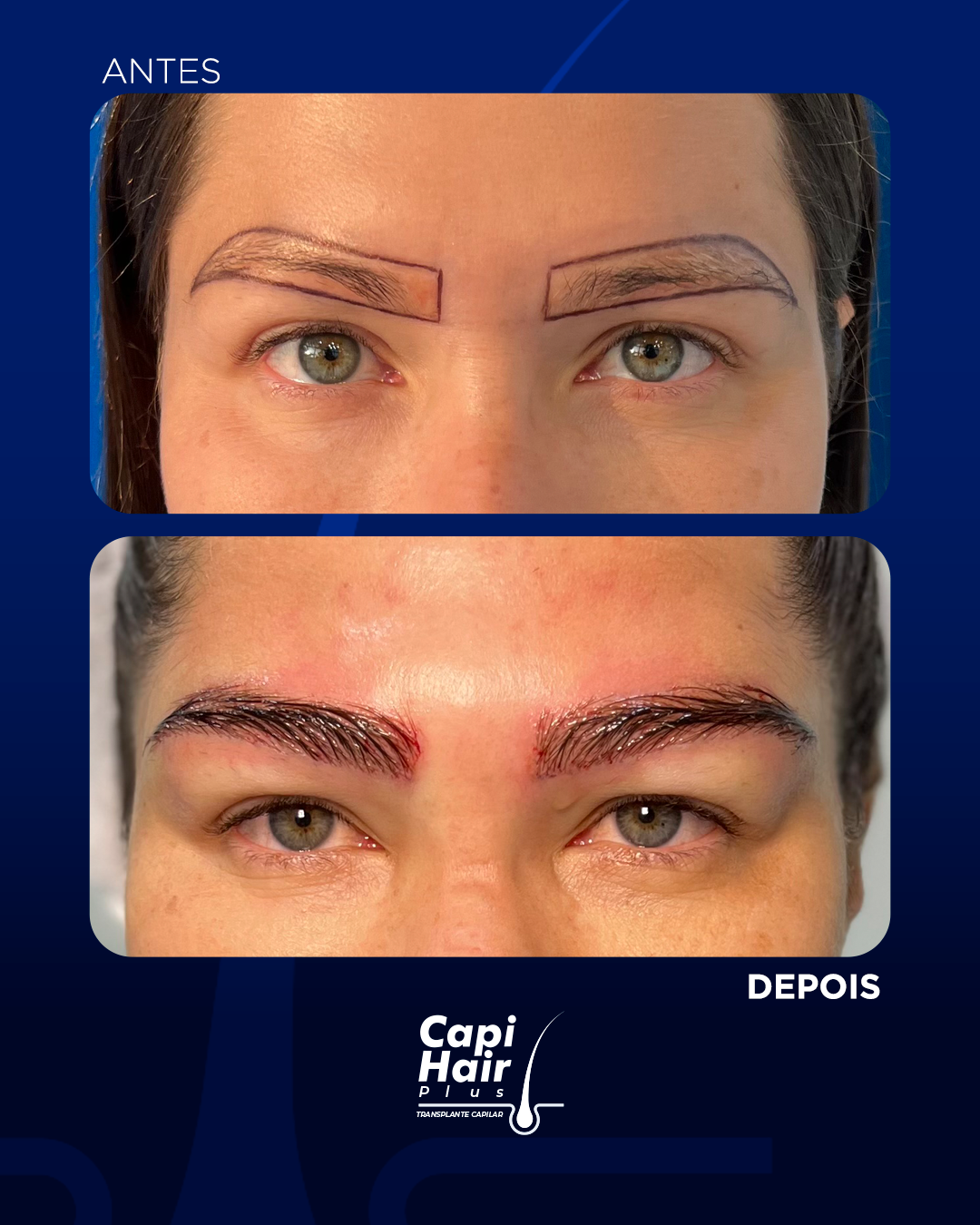 capihair-antes-depois-pacientes (6)