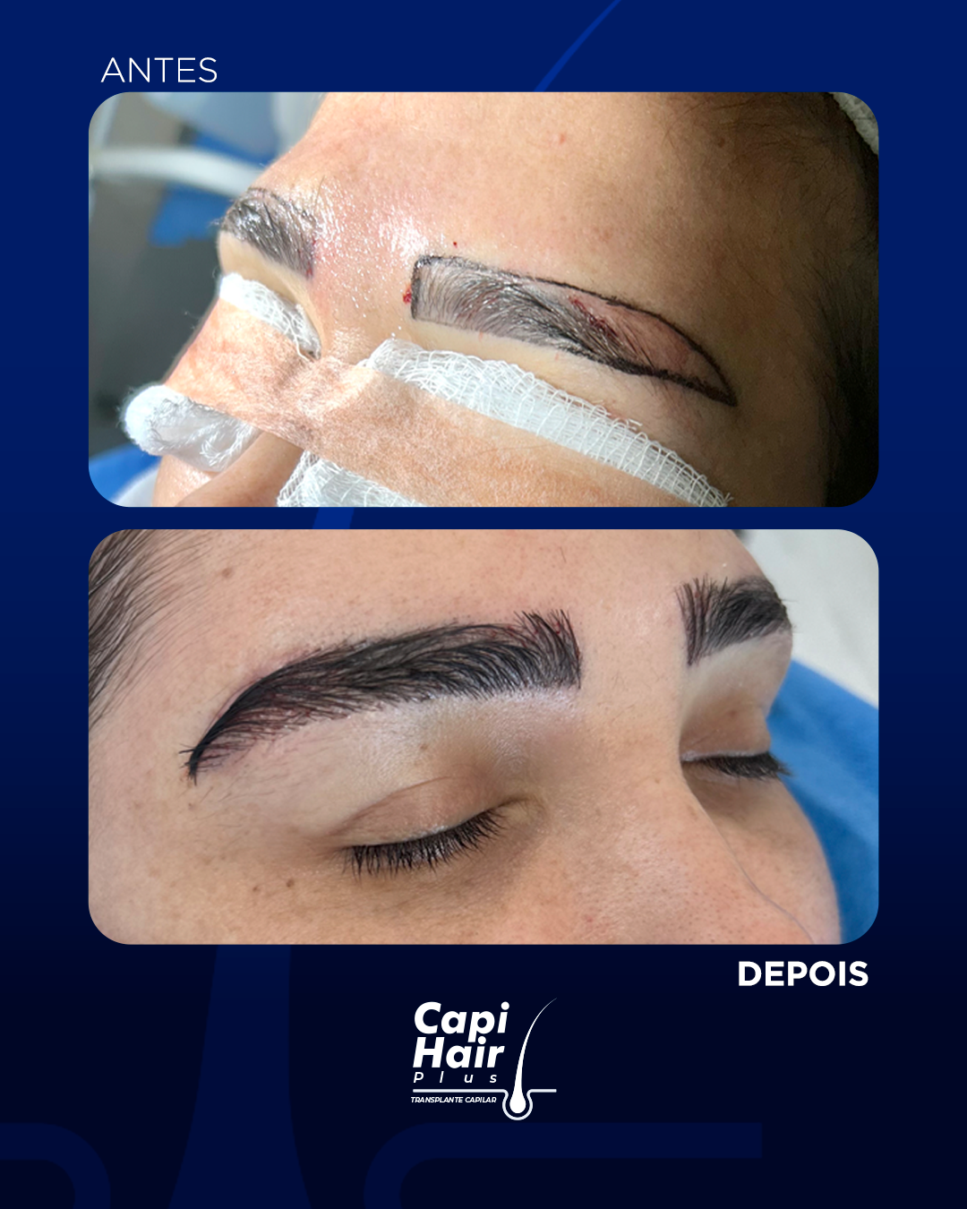 capihair-antes-depois-pacientes (7)