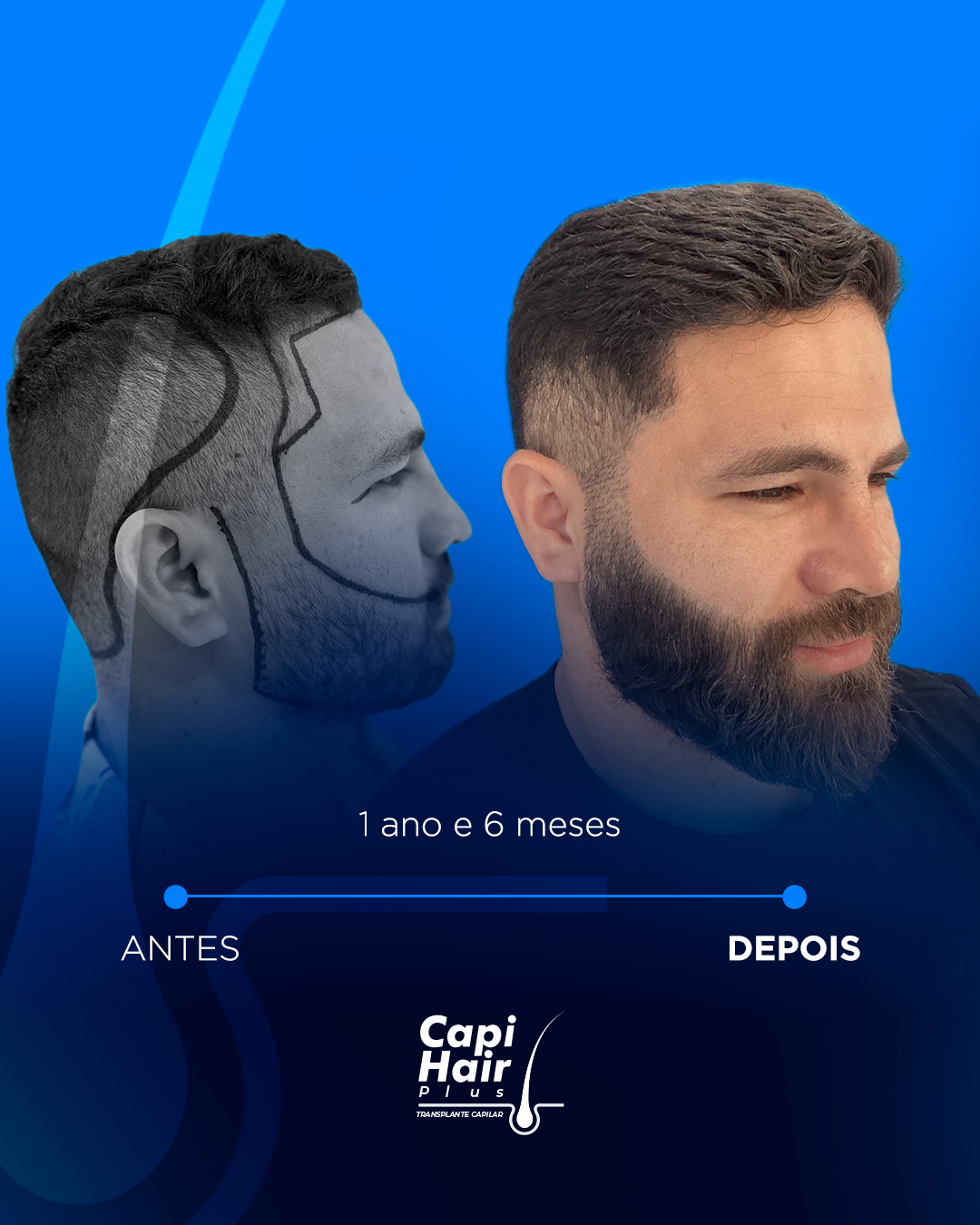 capihair-antes-depois-pacientes-9