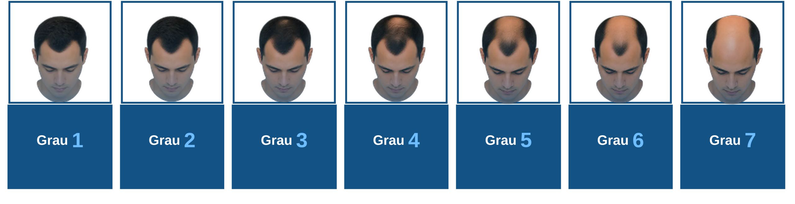 Escala de Norwood - grau de calvície